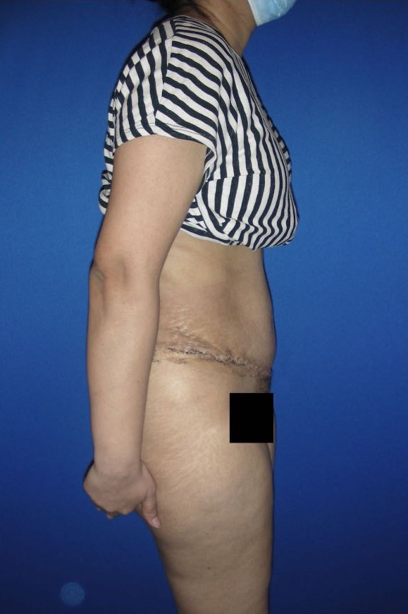 Tummy Tuck Patient Photo - Case 3944 - after view-4