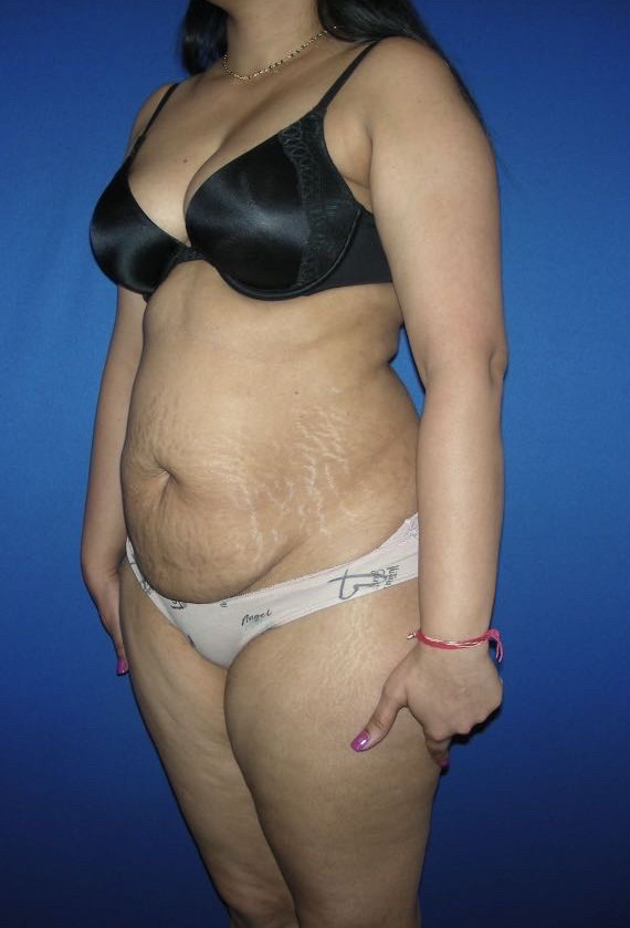 Tummy Tuck Patient Photo - Case 3944 - before view-1