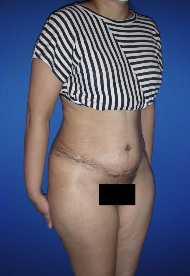 Tummy Tuck Patient Photo - Case 3944 - after view-3