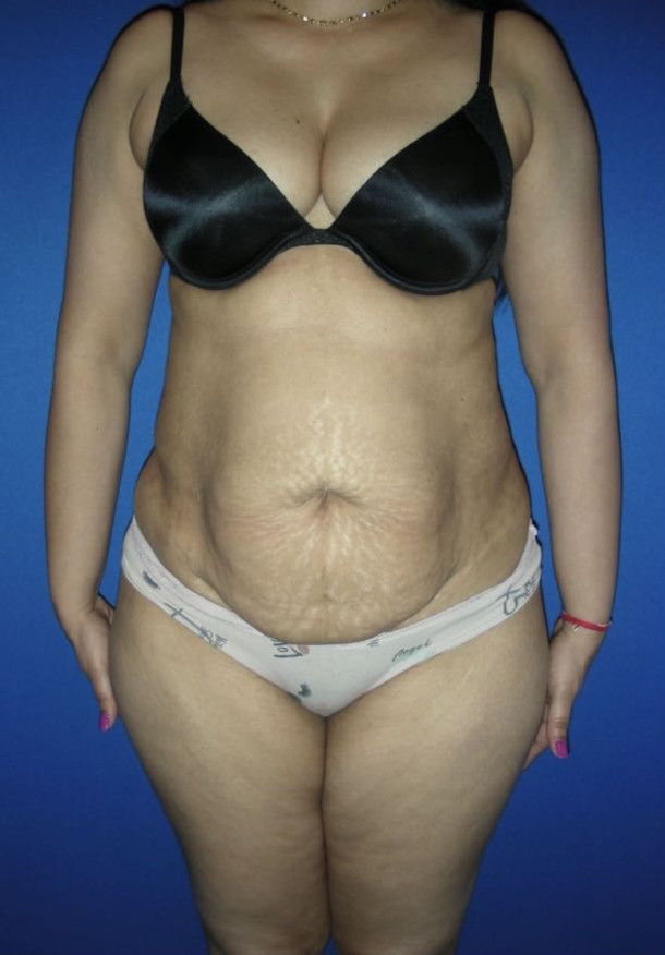 Tummy Tuck Patient Photo - Case 3944 - before view-0