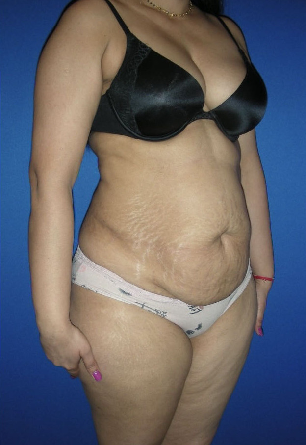 Tummy Tuck Patient Photo - Case 3944 - before view-3