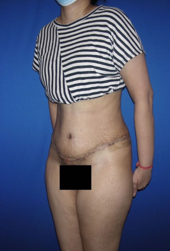 Tummy Tuck Patient Photo - Case 3944 - after view-1