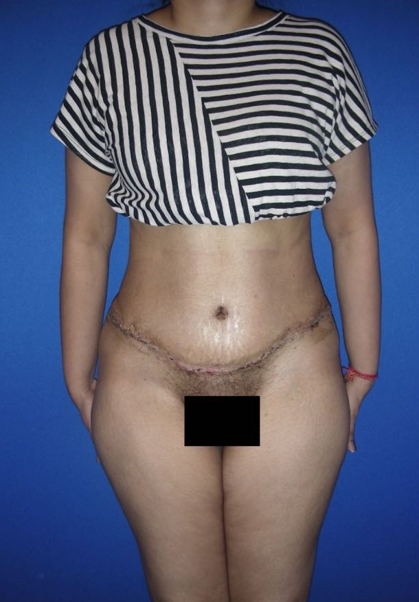 Tummy Tuck Patient Photo - Case 3944 - after view-0