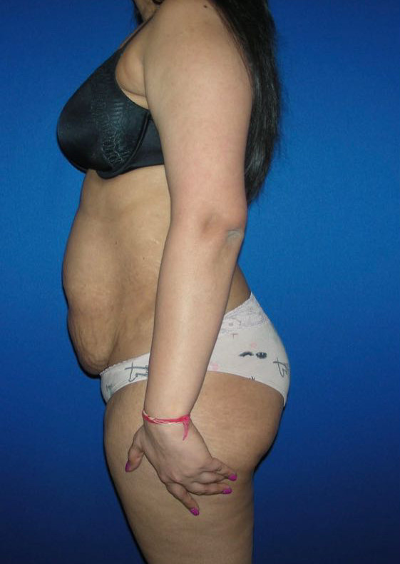 Tummy Tuck Patient Photo - Case 3944 - before view-2