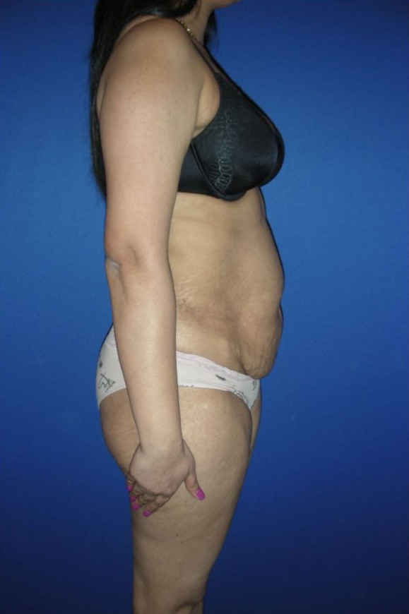 Tummy Tuck Patient Photo - Case 3944 - before view-4