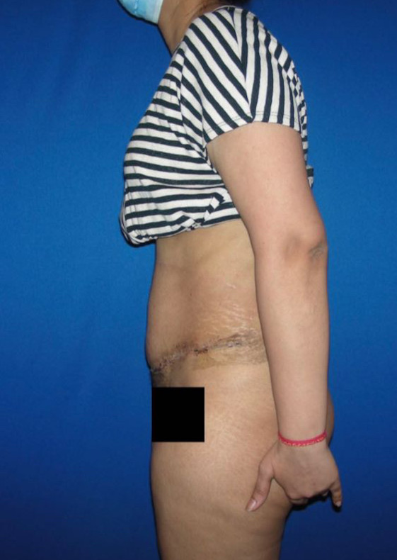 Tummy Tuck Patient Photo - Case 3944 - after view-2
