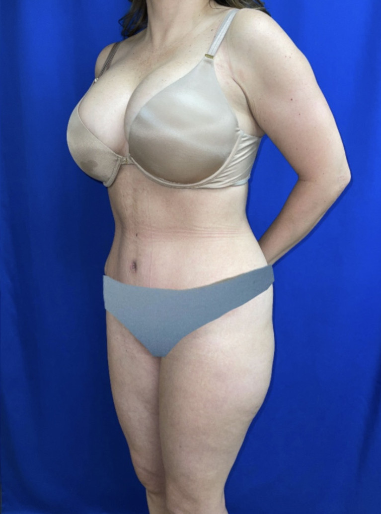 Tummy Tuck Patient Photo - Case 3955 - after view