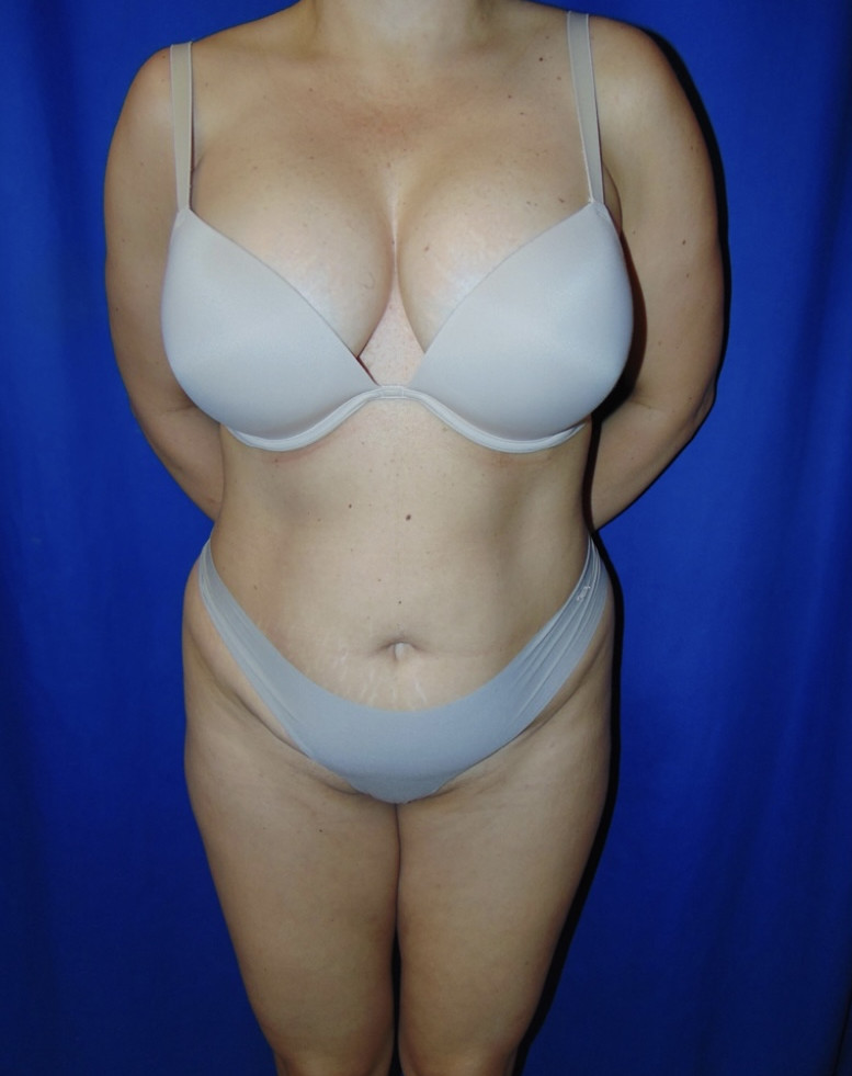 Tummy Tuck Patient Photo - Case 3955 - before view-0
