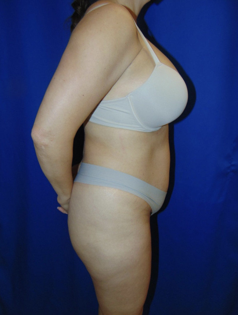 Tummy Tuck Patient Photo - Case 3955 - before view-