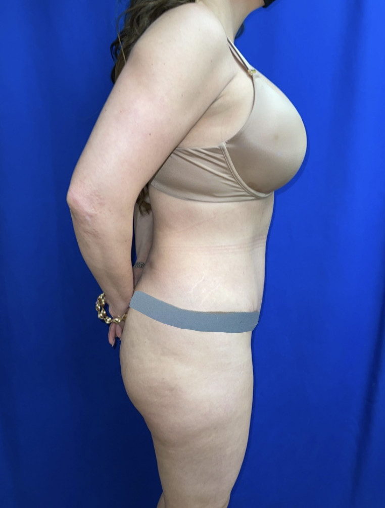 Tummy Tuck Patient Photo - Case 3955 - after view