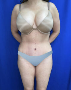 Tummy Tuck - Case 3955 - After