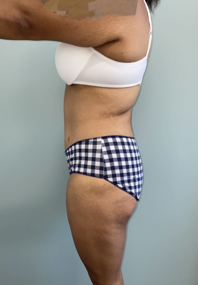 Tummy Tuck Patient Photo - Case 3962 - after view