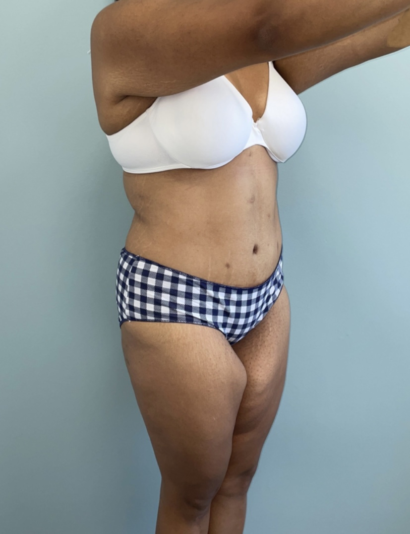 Tummy Tuck Patient Photo - Case 3962 - after view