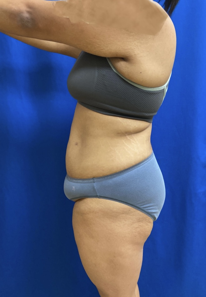 Tummy Tuck Patient Photo - Case 3962 - before view-