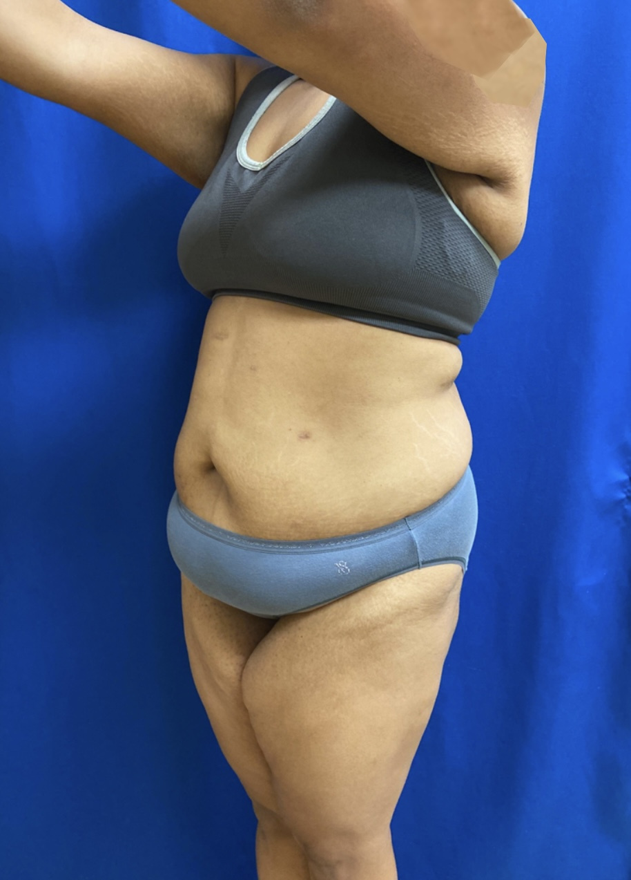 Tummy Tuck Patient Photo - Case 3962 - before view-1