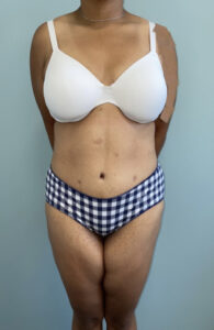 Tummy Tuck - Case 3962 - After