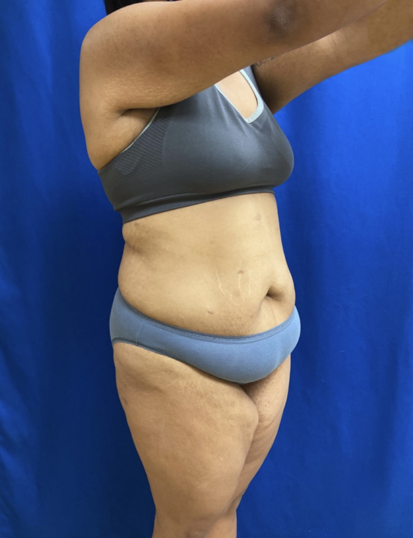 Tummy Tuck Patient Photo - Case 3962 - before view-3