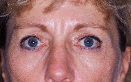 Injectables Patient Photo - Case 3988 - before view-0