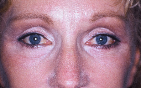 Injectables Patient Photo - Case 3988 - after view-0