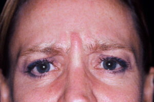 Injectables - Case 3991 - Before