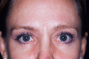 Injectables - Case 3991 - After