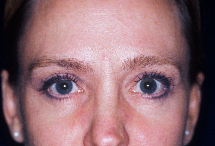 Injectables Patient Photo - Case 3991 - after view