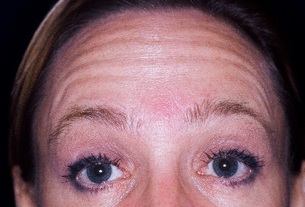 Injectables Patient Photo - Case 3991 - before view-1