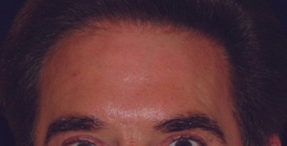 Injectables Patient Photo - Case 3996 - after view-0