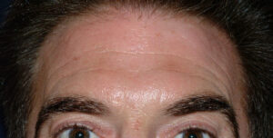 Injectables - Case 3996 - Before