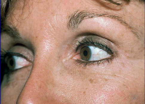 Blepharoplasty Patient Photo - Case 3999 - after view-0