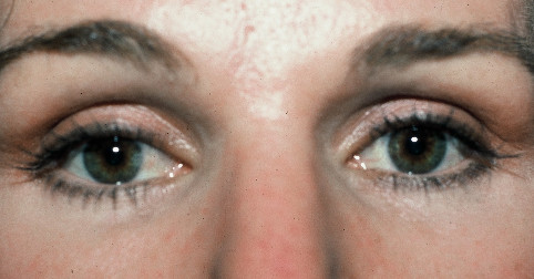 Blepharoplasty Patient Photo - Case 4002 - after view