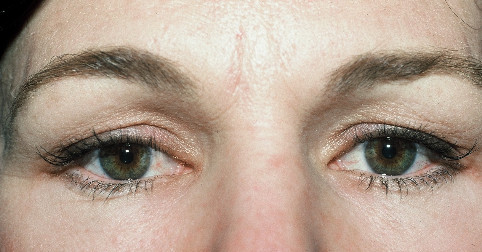 Blepharoplasty Patient Photo - Case 4002 - before view-