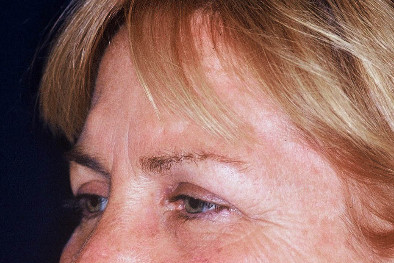 Blepharoplasty Patient Photo - Case 4005 - before view-