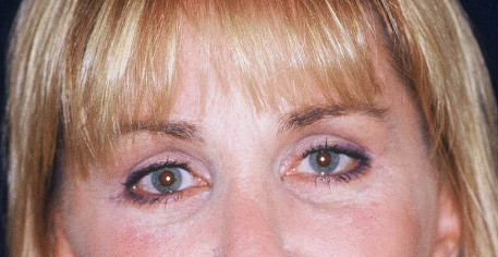 Blepharoplasty Patient Photo - Case 4005 - after view-1