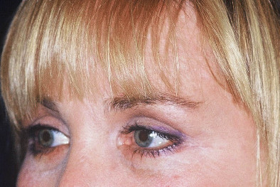 Blepharoplasty Patient Photo - Case 4005 - after view