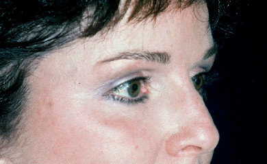 Blepharoplasty Patient Photo - Case 4010 - after view-0