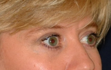 Blepharoplasty Patient Photo - Case 4013 - after view-0
