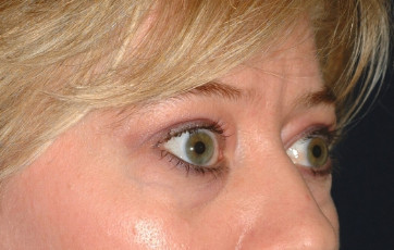 Blepharoplasty Patient Photo - Case 4013 - before view-0