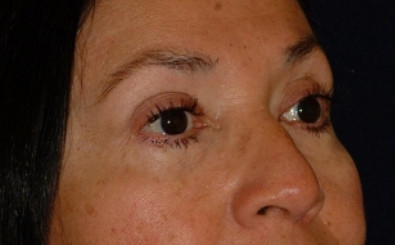 Blepharoplasty Patient Photo - Case 4016 - after view-2