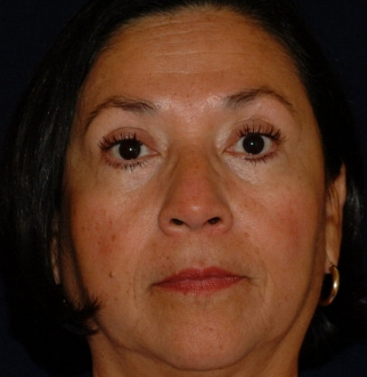 Blepharoplasty Patient Photo - Case 4016 - after view-0