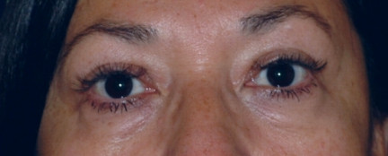 Blepharoplasty Patient Photo - Case 4016 - before view-