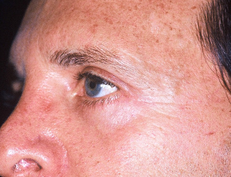 Blepharoplasty Patient Photo - Case 4023 - after view-0