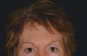 Brow Lift - Case 4034 - Before