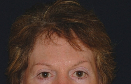 Brow Lift Patient Photo - Case 4034 - before view-0