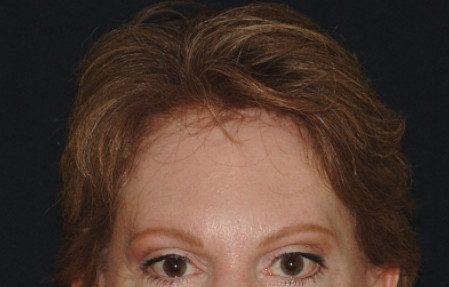 Brow Lift Patient Photo - Case 4034 - after view