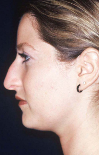 Rhinoplasty Patient Photo - Case 4040 - before view-
