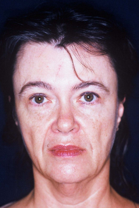 Blepharoplasty Patient Photo - Case 4048 - before view-1