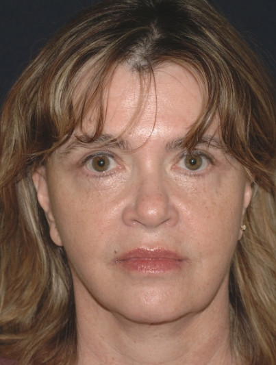 Blepharoplasty Patient Photo - Case 4048 - after view-0