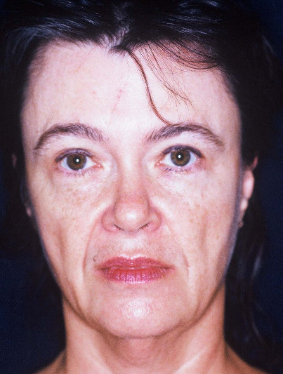 Blepharoplasty Patient Photo - Case 4048 - before view-