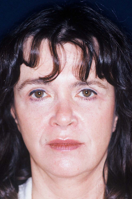 Blepharoplasty Patient Photo - Case 4048 - after view-1